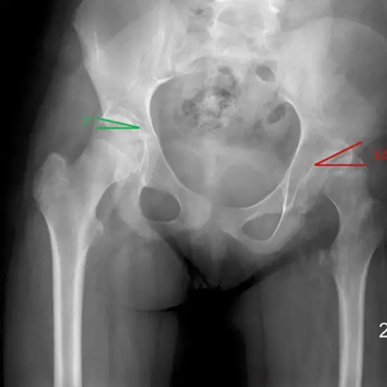 X-ray Right Upper Femur-HIP LAT